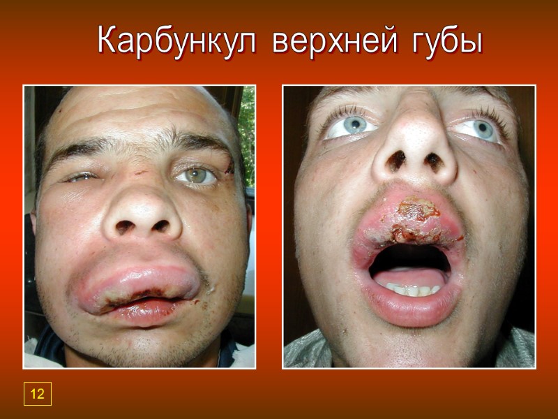 Карбункул верхней губы 12